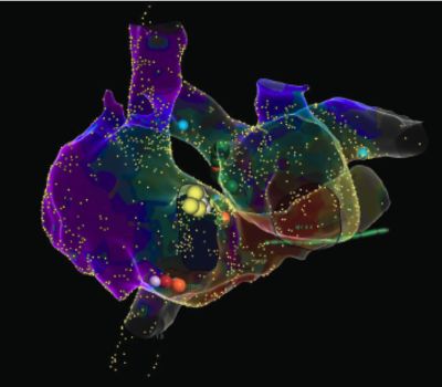 3D RFA / EP (Ablation (CARTO, Ensite)) 
