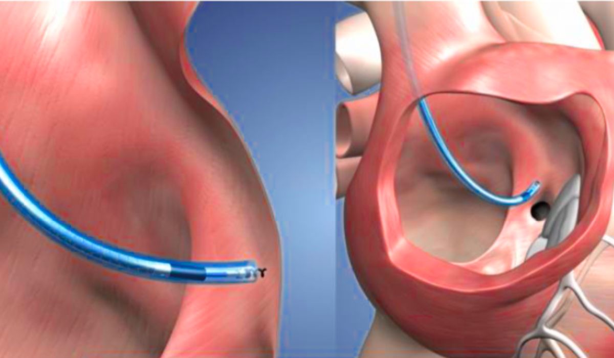Conduction System Pacing