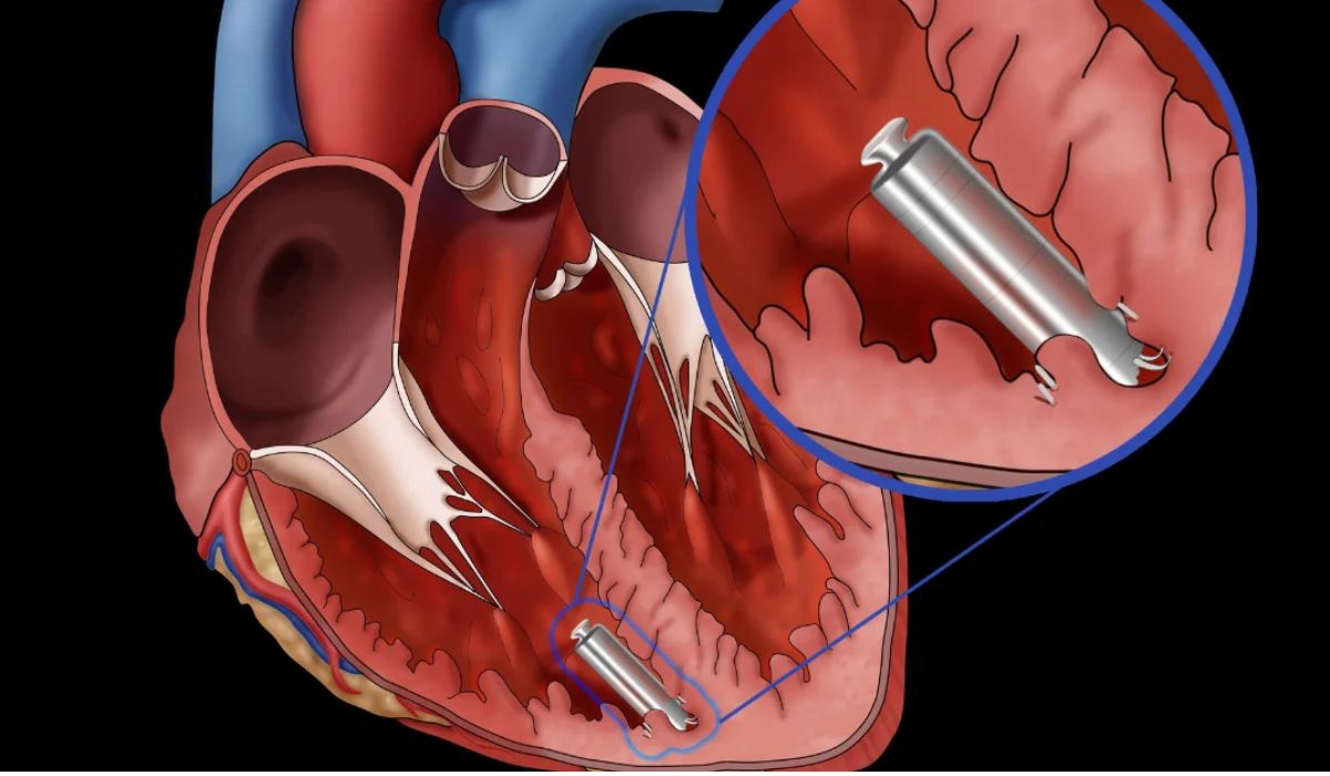 Leadless Pacemaker